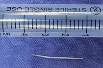 Chiếc xương cá dài 2,5cm được lấy từ sàn miệng bệnh nhân