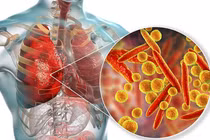 Virus Mycoplasma pneumoniae gây viêm phổi ở trẻ (ảnh BVCC)