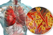 Virus Mycoplasma pneumoniae gây viêm phổi ở trẻ (ảnh BVCC)
