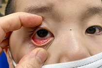 Người mắc bệnh đau mắt đỏ tuyệt đối không tự ý sử dụng các thuốc nhỏ mắt có chứa corticoid (ảnh BV Nhi TW)