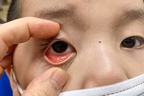 Người mắc bệnh đau mắt đỏ tuyệt đối không tự ý sử dụng các thuốc nhỏ mắt có chứa corticoid (ảnh BV Nhi TW)