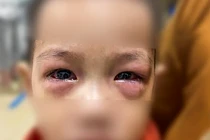 Trẻ bị đau mắt đỏ và gặp biến chứng nặng (ảnh BVCC)