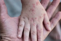 Bệnh đậu mùa khỉ thường có các triệu chứng như sốt, đau đầu, đau cơ, đau lưng, sưng hạch bạch huyết, ớn lạnh, mệt mỏi, phát ban có thể nhìn giống như mụn nước. Ảnh: Internet.