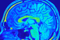 Hình chụp công hưởng từ não. Ảnh: FocalFinder/Shutterstock