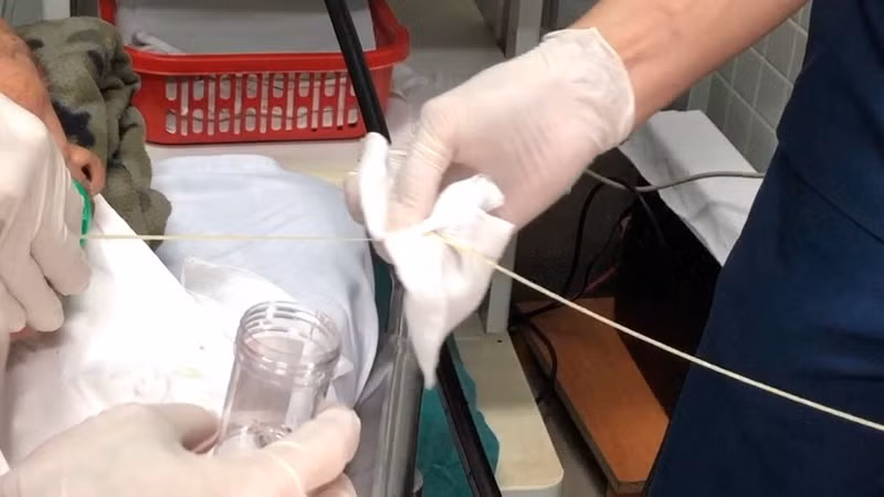 Một phần con sán dây bò được lấy ra khỏi tá tràng của bệnh nhân. Ảnh: BVCC