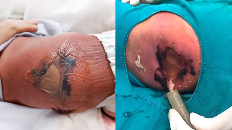 Em bé sơ sinh bị bỏng nặng, hoại tử da vì mẹ cho nằm than