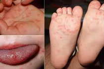 Bệnh tay chân miệng đang gia tăng nhanh. Ảnh minh họa