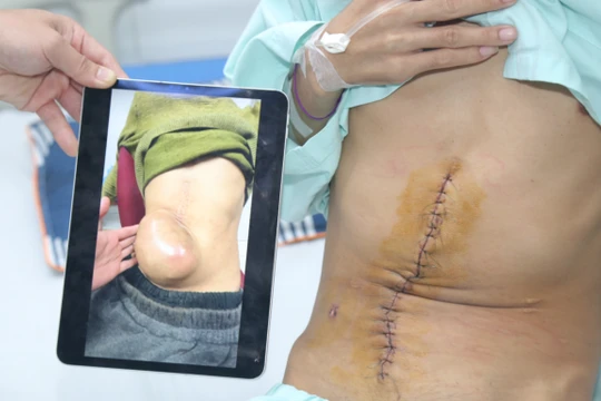 So sánh khối u lúc bệnh nhân đến BV và vết mổ sau khi cắt khối u