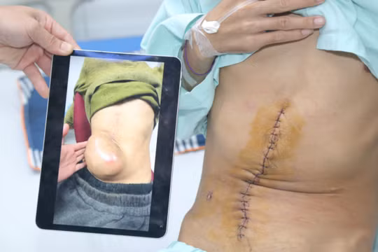 So sánh khối u lúc bệnh nhân đến BV và vết mổ sau khi cắt khối u