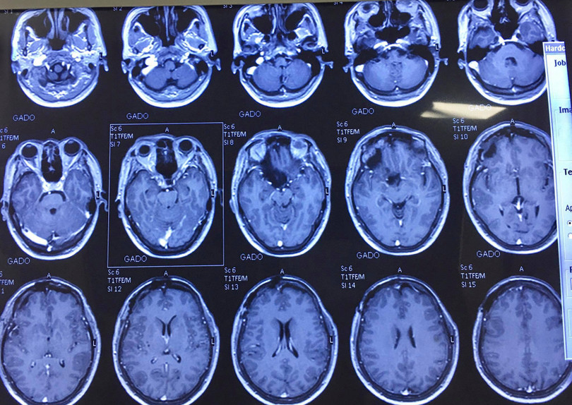 Phim chụp của bệnh nhân sau phẫu thuật. Ảnh: Bệnh viện Hữu nghị Việt Đức Phim chụp của bệnh nhân sau phẫu thuật. Ảnh: Bệnh viện Hữu nghị Việt Đức