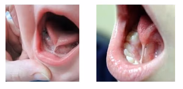 Hình ảnh trẻ bị dính lưỡi. Ảnh: Bệnh viện Nhi Trung ương