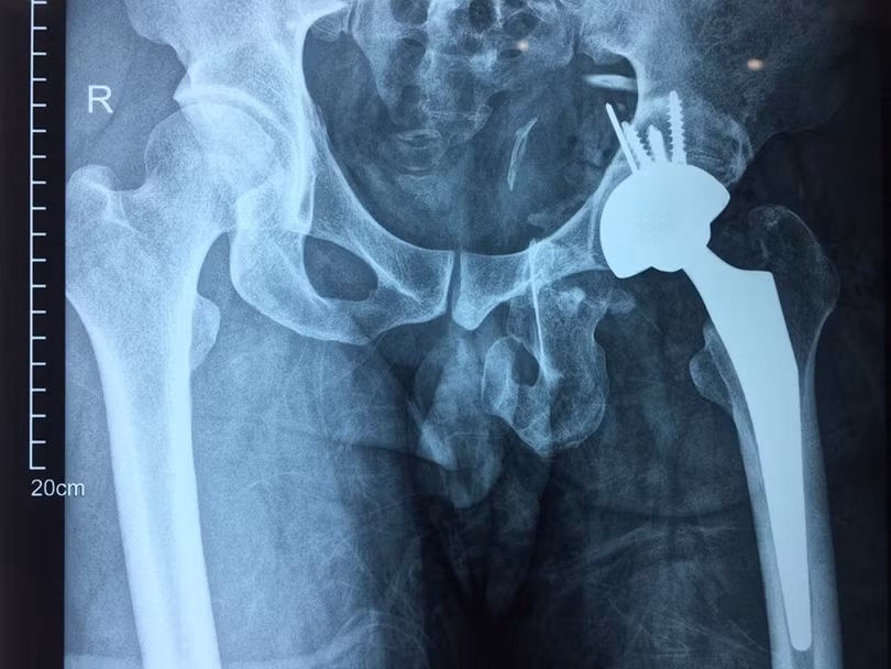 Phim chụp X-quang của bệnh nhân sau phẫu thuật thay khớp háng. Ảnh: Bệnh viện Hữu nghị Việt Đức