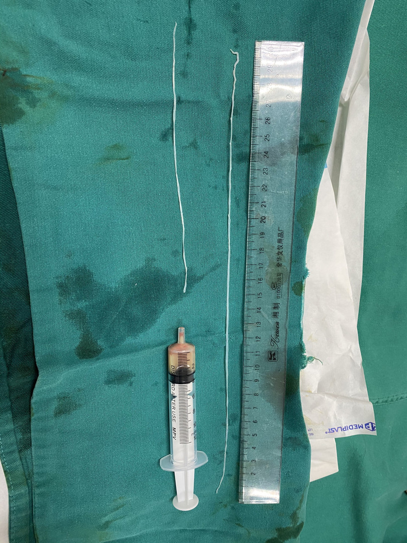 Giun Dracunculus medinensis được găp ra từ cơ thể bệnh nhân. Ảnh: Bệnh viện Bệnh Nhiệt đới Trung ương Giun Dracunculus medinensis được găp ra từ cơ thể bệnh nhân. Ảnh: Bệnh viện Bệnh Nhiệt đới Trung ương