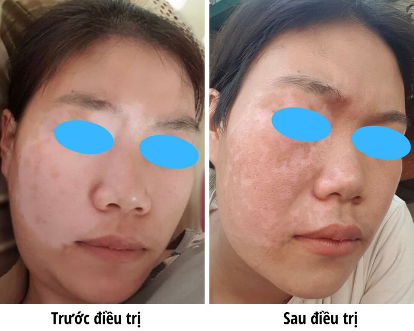 Bệnh nhân bạch biến sau 3 tháng điều trị. Ảnh: Bệnh viện Da liễu Trung ương