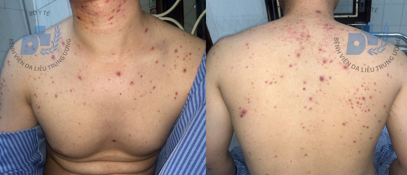 Sau hơn 1 tháng sử dụng thuốc nam, bệnh nhân xuất hiện thêm nhiều tổn thương sẩn mụn mủ kích thước đồng đều, rải rác vùng thân mình, cánh tay 2 bên.