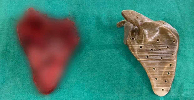 Khối u và xương bả vai nhân tạo của bé trai nhìn từ phía sau (Ảnh: PGS. TS. Trần Trung Dũng)