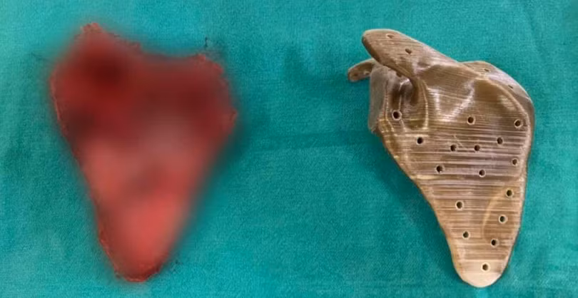 Khối u và xương bả vai nhân tạo của bé trai nhìn từ phía sau (Ảnh: PGS. TS. Trần Trung Dũng)