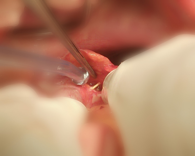 Hình ảnh chiếc tăm tre đâm thủng đại tràng của bệnh nhân. Ảnh: BS. Hoàng Việt Dũng Hình ảnh chiếc tăm tre đâm thủng đại tràng của bệnh nhân. Ảnh: BS. Hoàng Việt Dũng