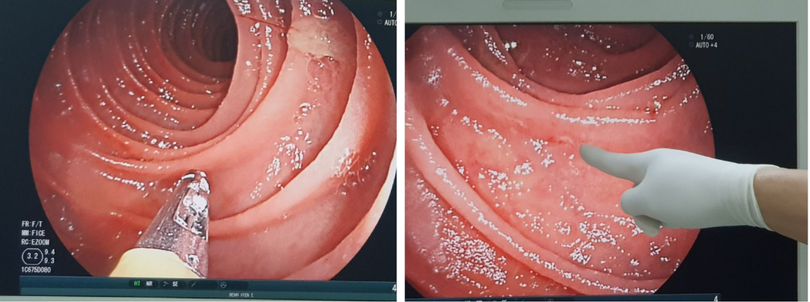 Bác sĩ tiến hành nội soi phát hiện giun mỏ trong ruột bệnh nhân. Ảnh: BVCC
