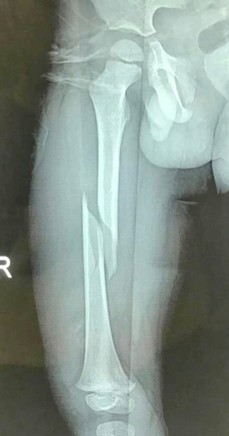 Phần xương đùi bị gãy của bệnh nhi. Ảnh: Bệnh viện Hữu Nghị Phần xương đùi bị gãy của bệnh nhi. Ảnh: Bệnh viện Hữu Nghị