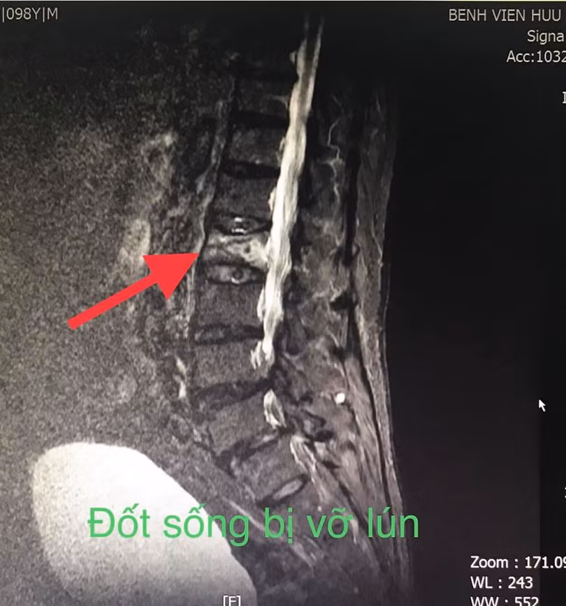 Đốt sống bị vỡ lún của bệnh nhân. Ảnh: BVCC