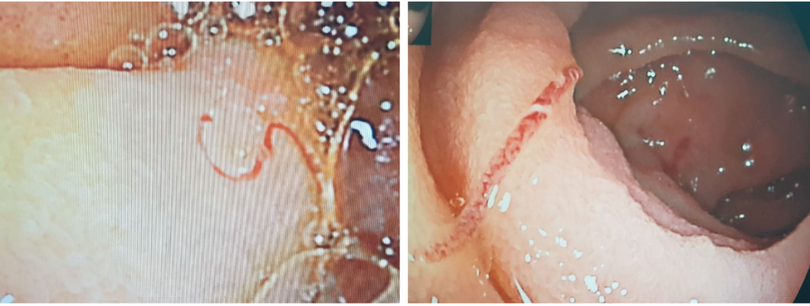 20 con giun mỏ hút máu trong ruột bệnh nhân. Ảnh: BVCC