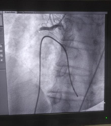 Hình ảnh huyết khối gây tắc cụt động mạch vành phải từ đoạn I. Ảnh: Bệnh viện Đa khoa Đức Giang Hình ảnh huyết khối gây tắc cụt động mạch vành phải từ đoạn I. Ảnh: Bệnh viện Đa khoa Đức Giang