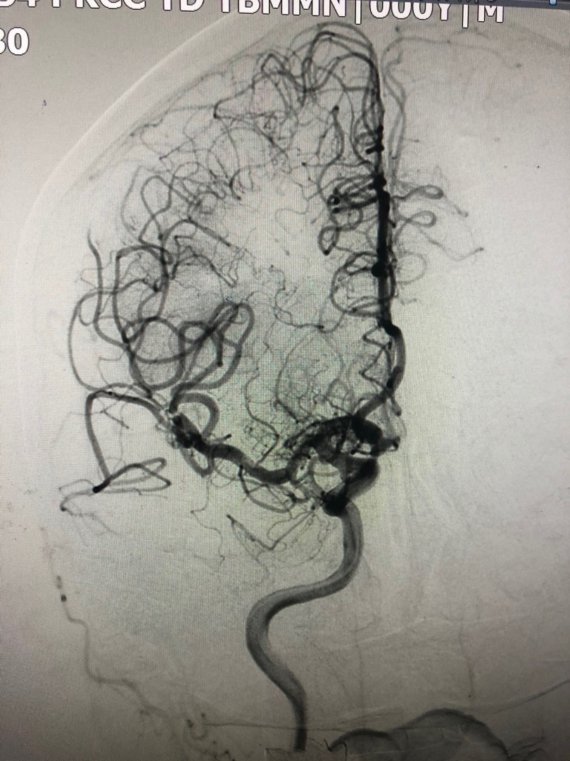 Tái thông động mạch não giữa sau can thiệp lấy huyết khối. Ảnh: BVCC Tái thông động mạch não giữa sau can thiệp lấy huyết khối. Ảnh: BVCC