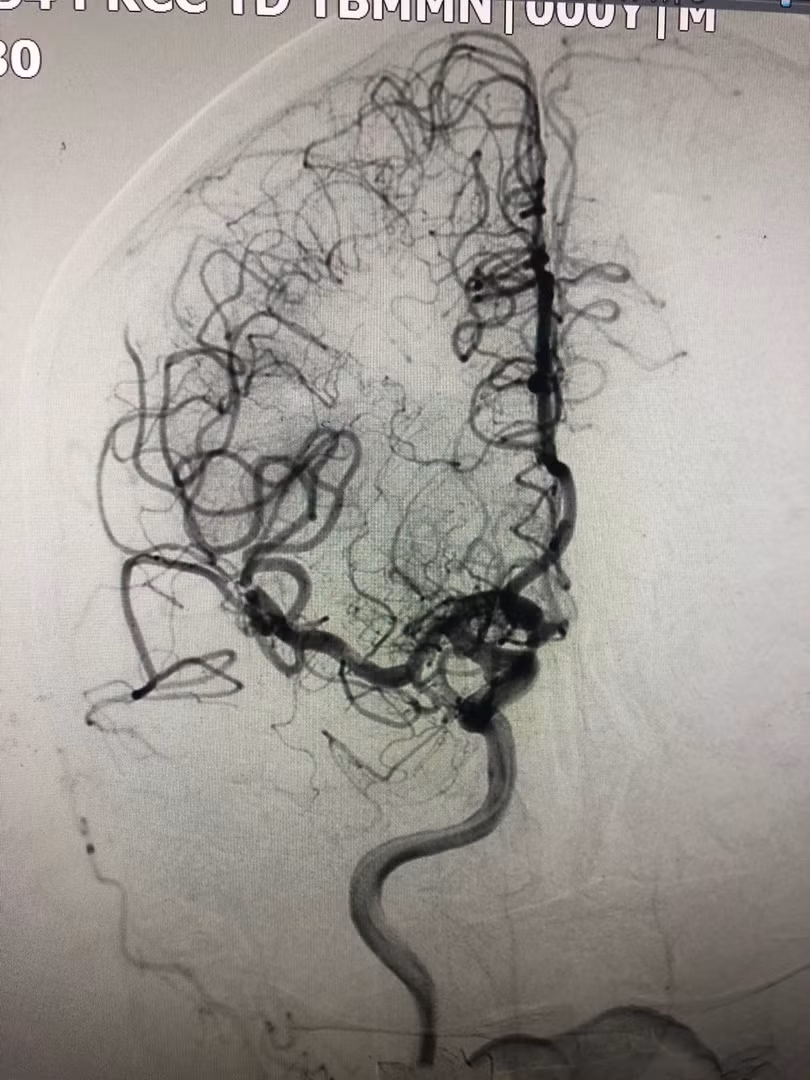 Tái thông động mạch não giữa sau can thiệp lấy huyết khối. Ảnh: BVCC