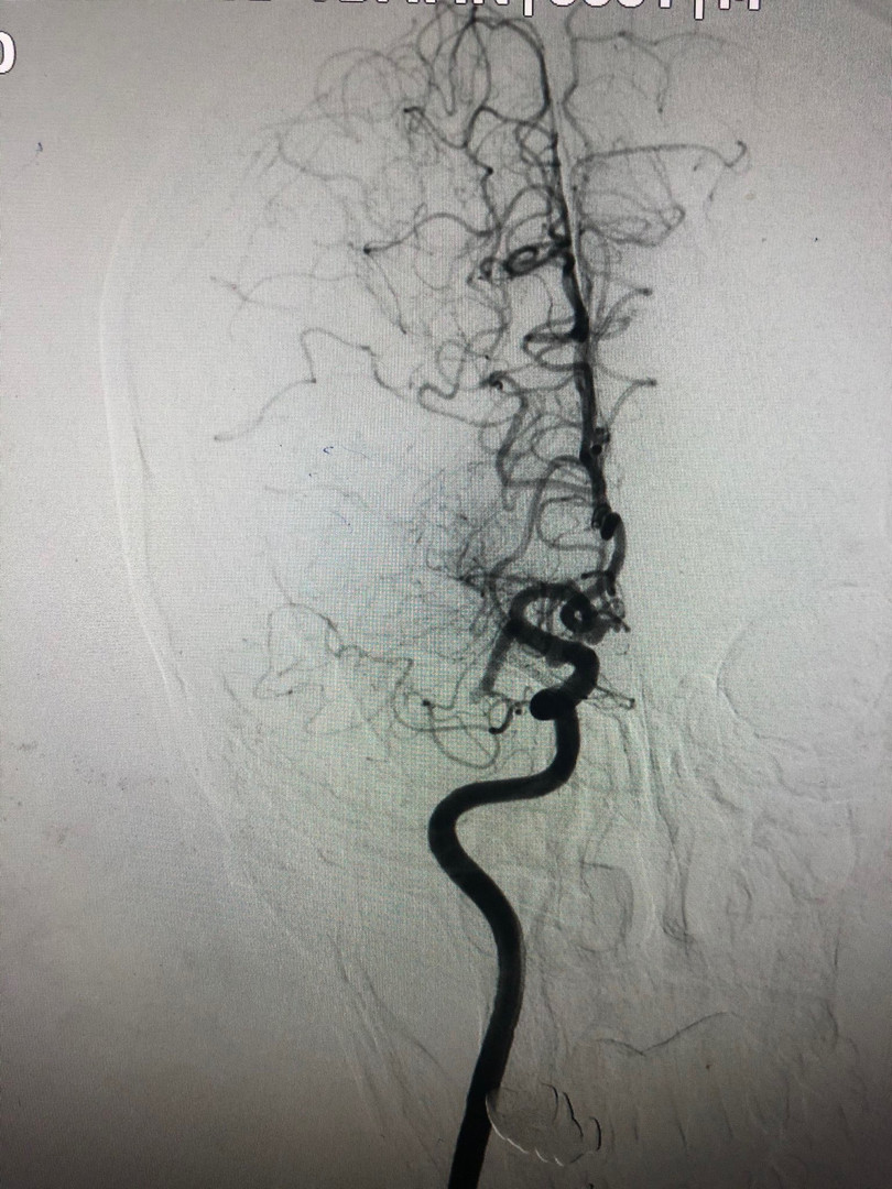 Chụp tắc động mạch não giữa đoạn M1 phải. Ảnh: BVCC Chụp tắc động mạch não giữa đoạn M1 phải. Ảnh: BVCC