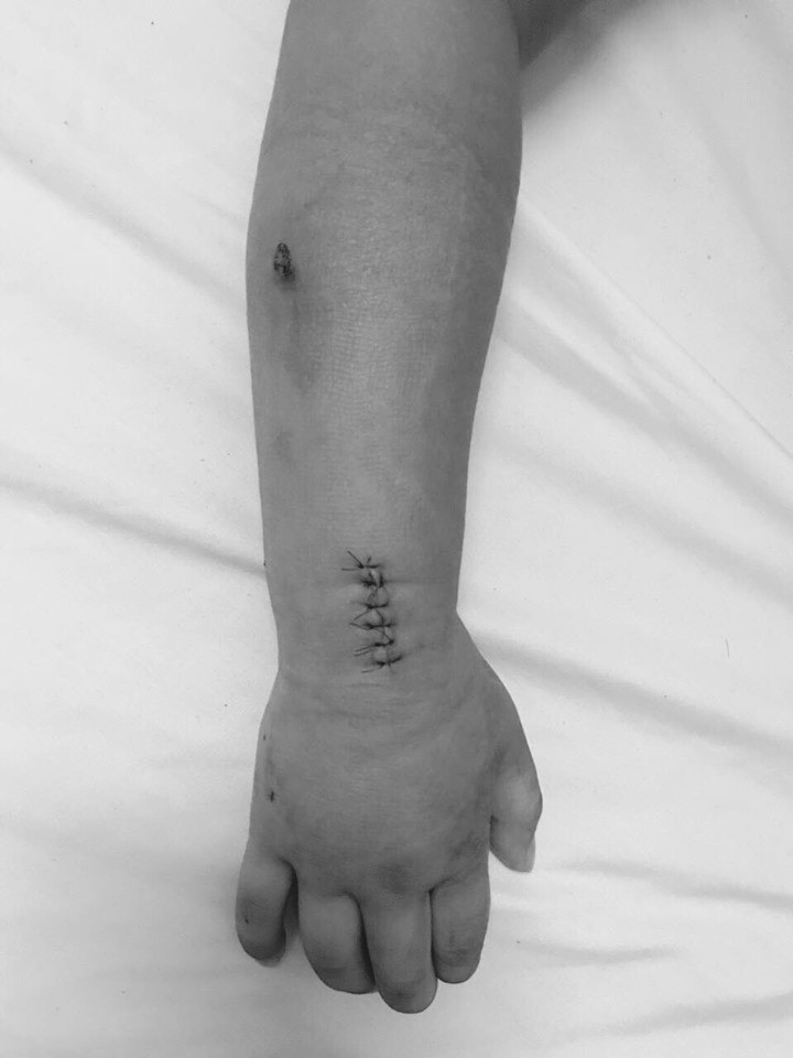 Tay bé trai sau ca phẫu thuật