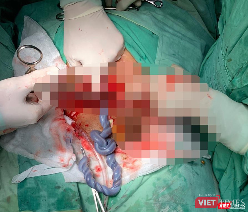 Hình ảnh dây rốn thắt nút