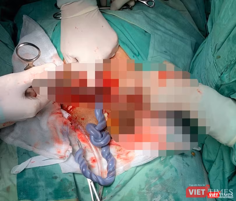 Hình ảnh dây rốn thắt nút Hình ảnh dây rốn thắt nút