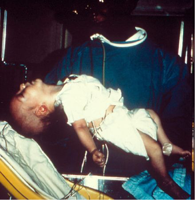 Trẻ bị ngộ độc: khó bú, khóc yếu, sa mí mắt và nhược trương. Nguồn: CDC