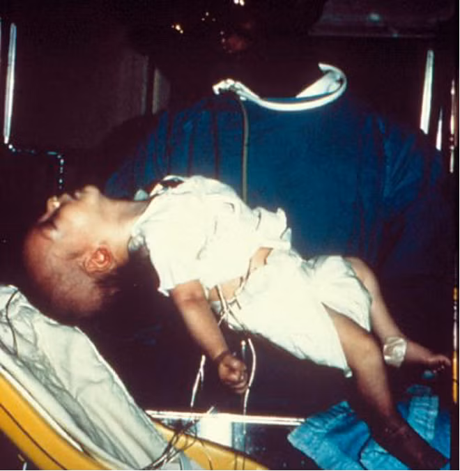 Trẻ bị ngộ độc: khó bú, khóc yếu, sa mí mắt và nhược trương. Nguồn: CDC Trẻ bị ngộ độc: khó bú, khóc yếu, sa mí mắt và nhược trương. Nguồn: CDC