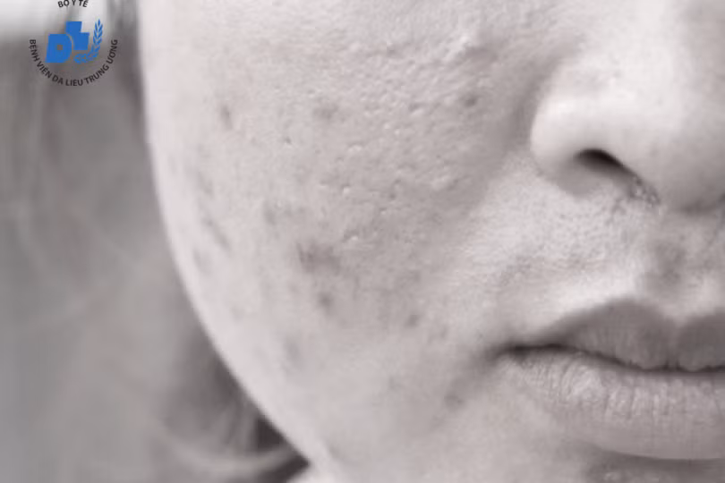 Sau điều trị, mụn trứng cá vẫn có thể tái phát (Ảnh: Bệnh viện Da liễu Trung ương)