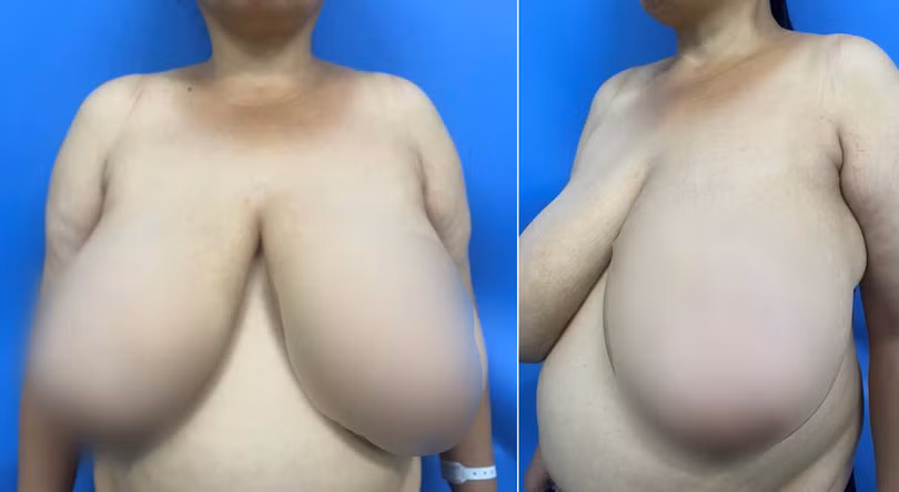 Cặp vú khổng lồ của bệnh nhân (Ảnh: BVCC)