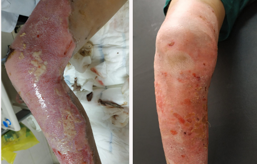 Phần đùi và cẳng chân bị hoại tử của bệnh nhi sau 13 ngày điều trị. Ảnh: BVCC Phần đùi và cẳng chân bị hoại tử của bệnh nhi sau 13 ngày điều trị. Ảnh: BVCC
