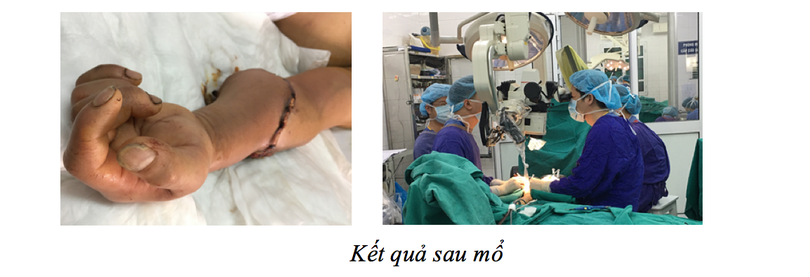 Cánh tay của bệnh nhân sau mổ. Ảnh: BVCC