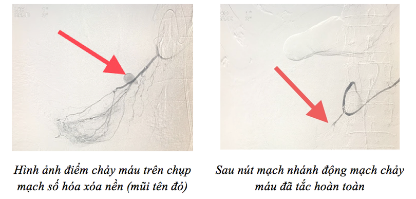 Bác sĩ áp dụng kỹ thuật nút mạch để cứu sống bệnh nhân. Ảnh: BVCC