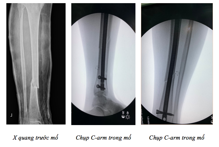 Phim chụp X-quang của bệnh nhân. Ảnh: BVCC