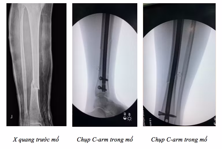 Phim chụp X-quang của bệnh nhân. Ảnh: BVCC