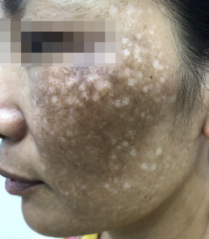 Cận cảnh vùng má bị tổn thương của bệnh nhân (Ảnh: BVCC) Cận cảnh vùng má bị tổn thương của bệnh nhân (Ảnh: BVCC)