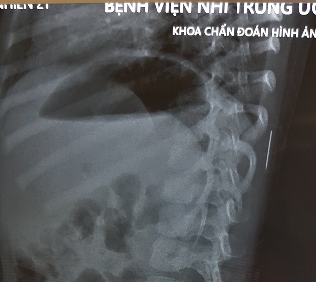 Hình ảnh X-quang chiếc kim khâu trong cơ thể bệnh nhi (Ảnh: BVCC)
