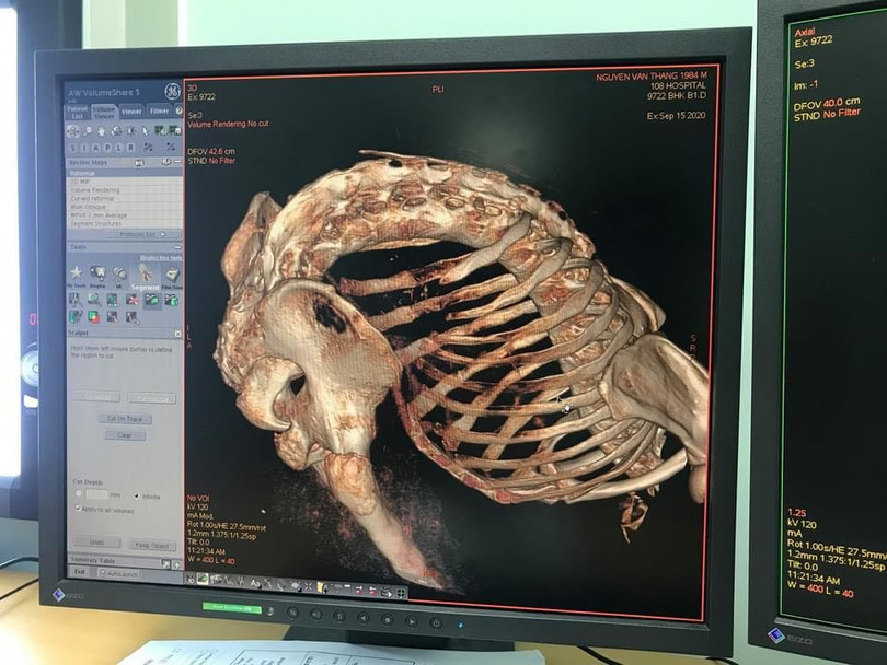 Hình ảnh cột sống của bệnh nhân bị con, gãy gập như con tôm (Ảnh: BVCC)