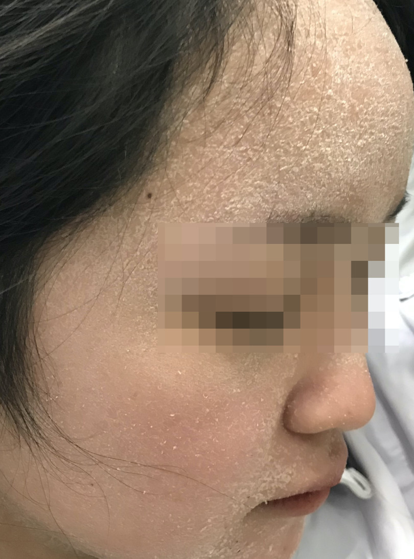 Một bệnh nhân da bị bong tróc đến khám tại Bệnh viện Da liễu Trung ương (Ảnh: BVCC) Một bệnh nhân da bị bong tróc đến khám tại Bệnh viện Da liễu Trung ương (Ảnh: BVCC)