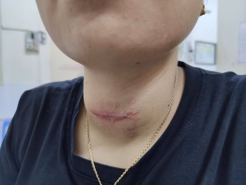 Cận cảnh vùng cổ của bệnh nhân Cận cảnh vùng cổ của bệnh nhân