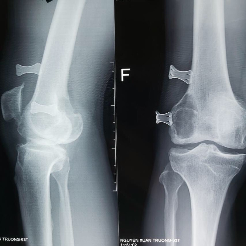 Phim chụp X-quang khớp gối của bệnh nhân (Ảnh: BVCC) Phim chụp X-quang khớp gối của bệnh nhân (Ảnh: BVCC)
