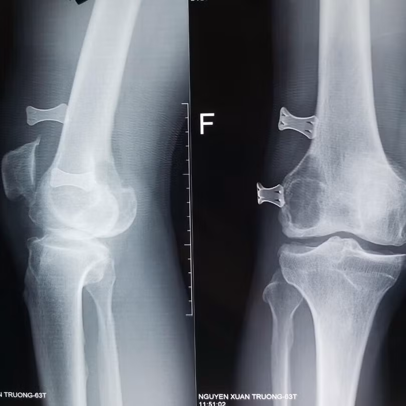 Phim chụp X-quang khớp gối của bệnh nhân (Ảnh: BVCC)