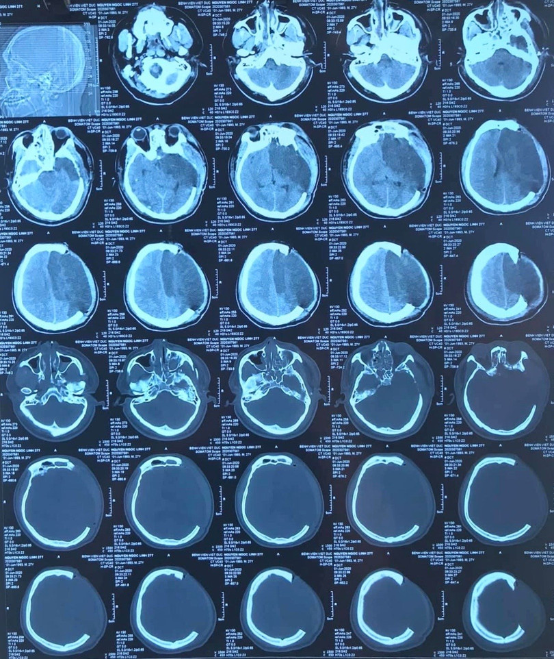 Ảnh chụp hộp sọ của bệnh nhân (Ảnh: BVCC)